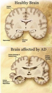 leeping Pills linked to Alzheimer’s Disease. Other Sleep Choices from Ross F. Grumet, SleepAdvocate