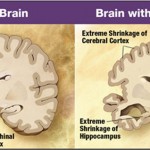 Sleeping Pills linked to Alzheimer’s Disease. Other Sleep Choices from Ross F. Grumet, SleepAdvocate