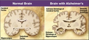 Sleeping Pills linked to Alzheimer’s Disease. Other Sleep Choices from Ross F. Grumet, SleepAdvocate