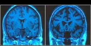 For alcohol, tobacco, drug, and other substance use problems, are the changes to brain circuits permanent or not?