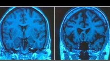 For alcohol, tobacco, drug, and other substance use problems, are the changes to brain circuits permanent or not?